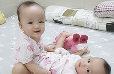 Международная пресса осветила операцию по разделению сиамских близнецов во Вьетнаме