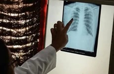 Вьетнам поделился опытом борьбы с туберкулезом на Всемирной конференции по туберкулезу и заболеваниям легких 2023 года