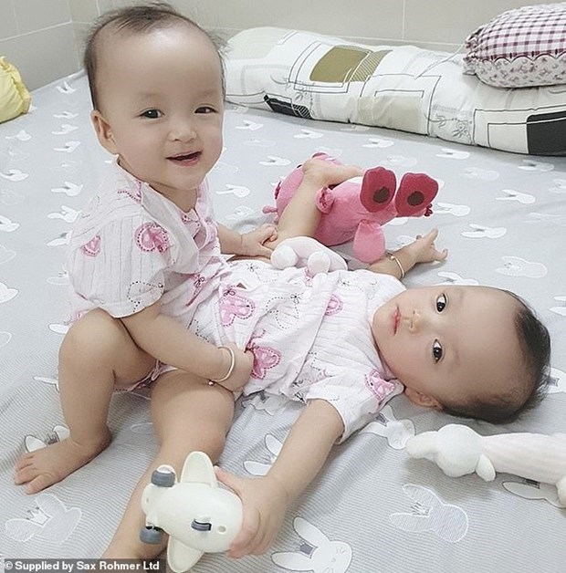 Международная пресса осветила операцию по разделению сиамских близнецов во Вьетнаме hinh anh 1